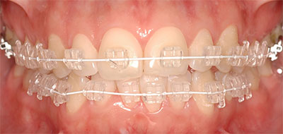 clear braces