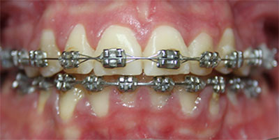 metal braces