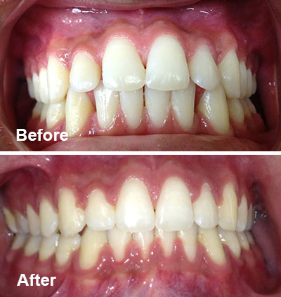 Orthodontic Spacing Case