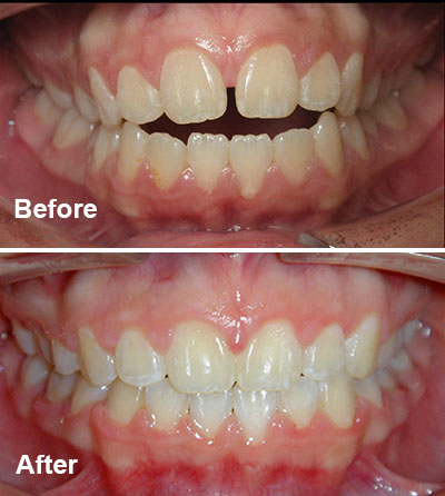 Orthodontic Open Bite Case