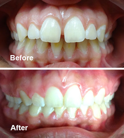 Orthodontic Overbite Case