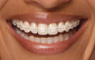 invisible braces