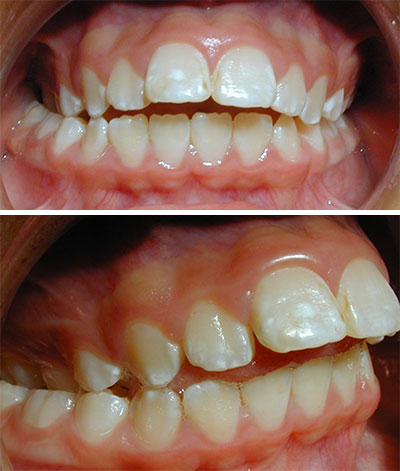 Orthodontic Crossbite