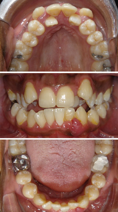 Orthodontic Crowding
