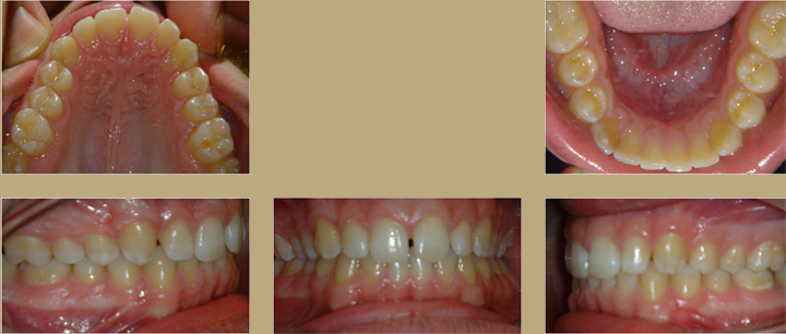 Invisalign 1