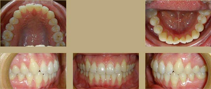 Invisalign 2