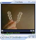 Invisalign Video