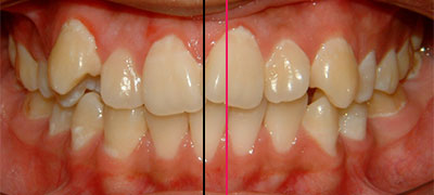 Orthodontic Midlines
