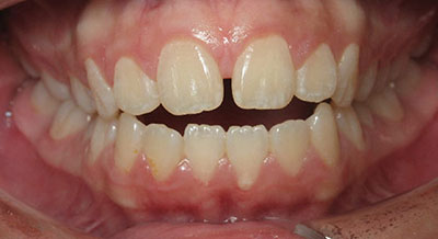 Orthodontic Openbite