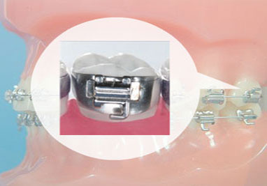 Orthodontic Band