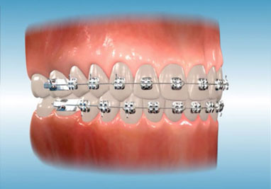 Orthodontic Braces