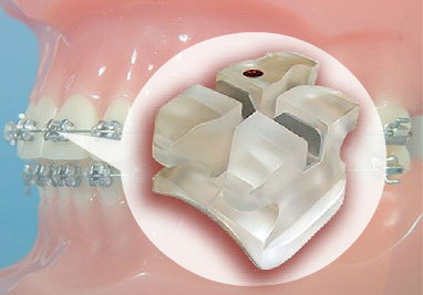 Orthodontic Brackets