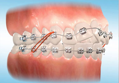 Elastics