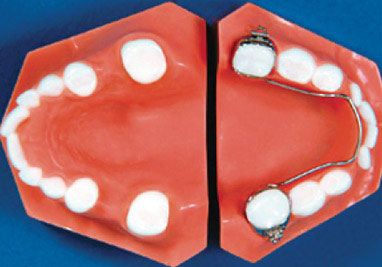 Orthodontic space Maintainer