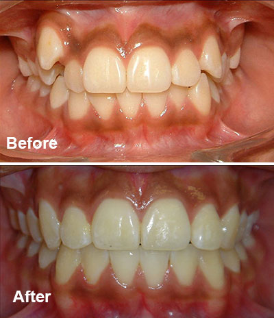 Orthodontic Crowding Case