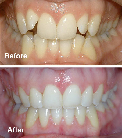 clear braces
