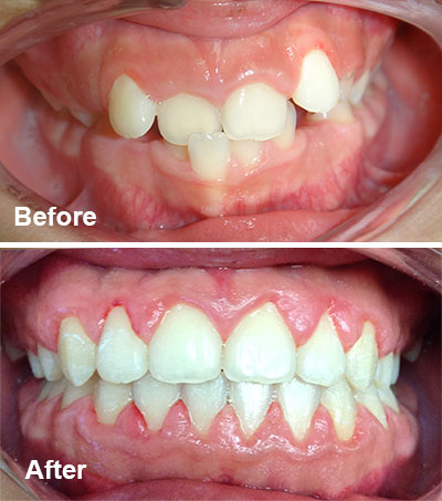 clear braces