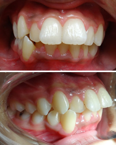 Orthodontic Overbite