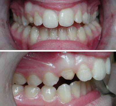 Orthodontic Protrusion