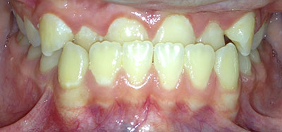 Orthodontic Underbite